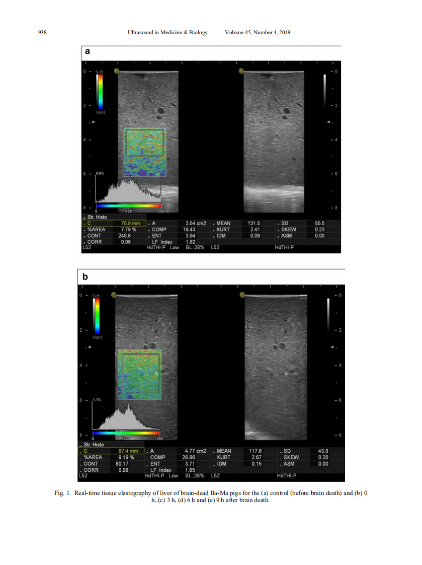 3）A comparison study of RTE and electron microscopy for assessment of liver damage.pdf 第4页