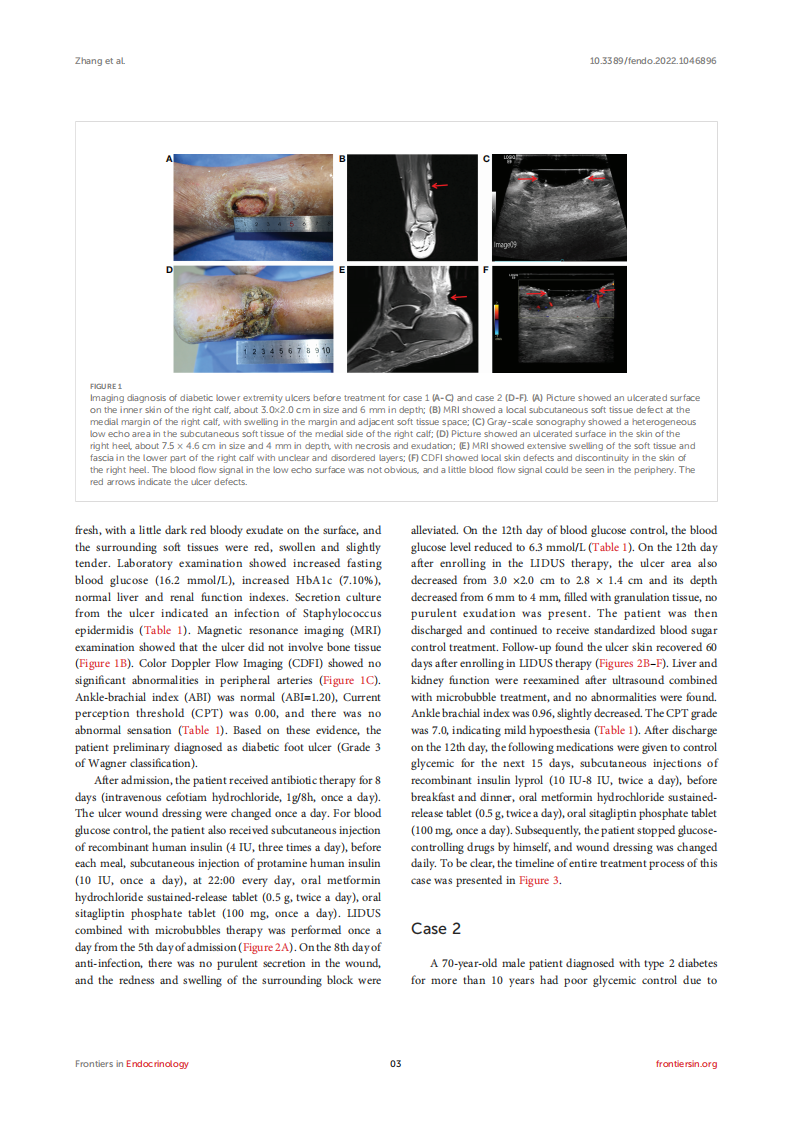 Case report-Successful treatment of human diabetic foot ulcer using low-intensity diagnostic ultrasound combined with microbubbles-Two cases.pdf 第3页
