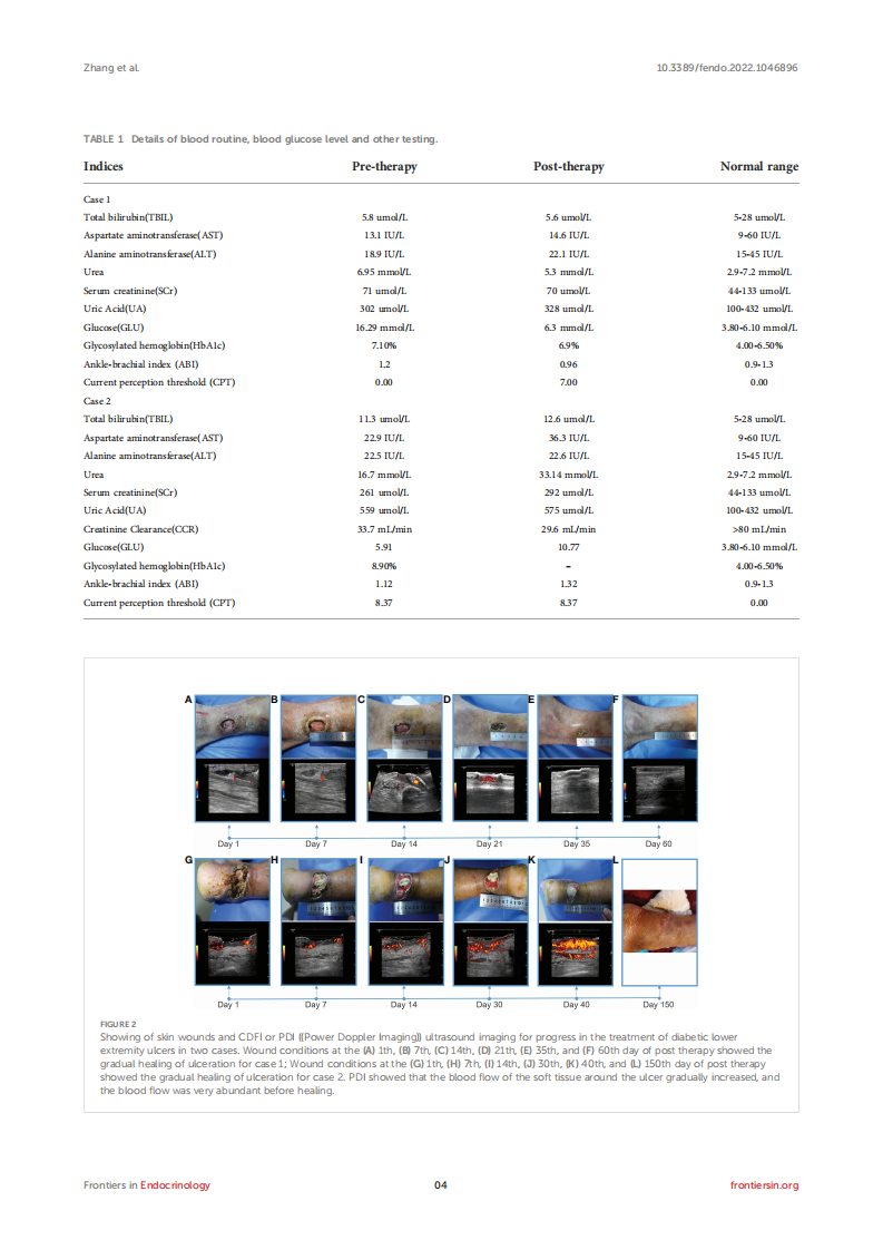 Case report-Successful treatment of human diabetic foot ulcer using low-intensity diagnostic ultrasound combined with microbubbles-Two cases.pdf 第4页