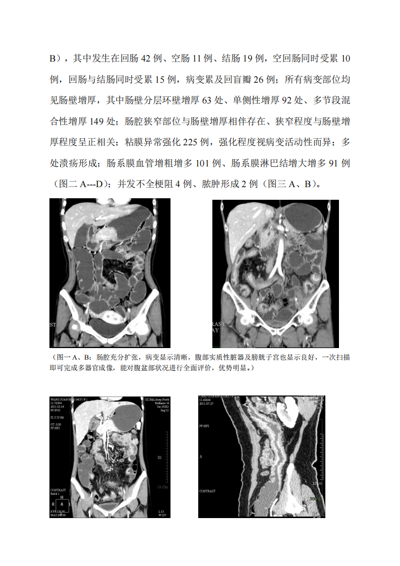 MSCT成像技术在肠道克罗恩病诊断中的应用价值.pdf 第4页