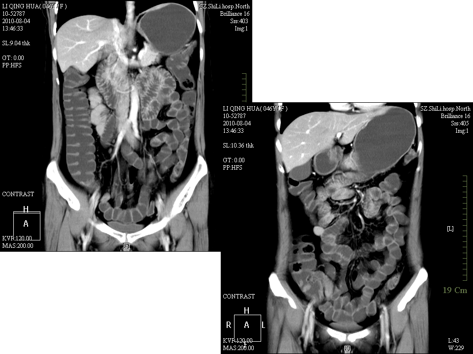 克罗恩病的MDCT诊断价值.ppt 第5页
