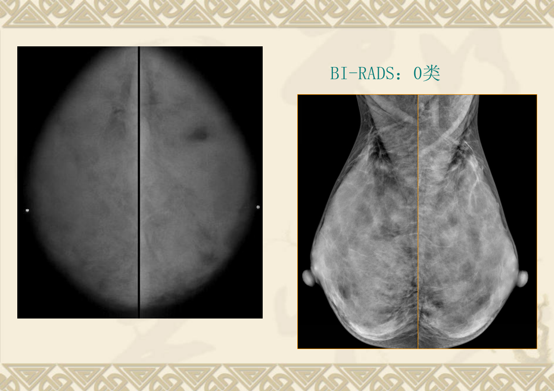 乳腺X线BI-RADS分类诊断解析.ppt 第5页