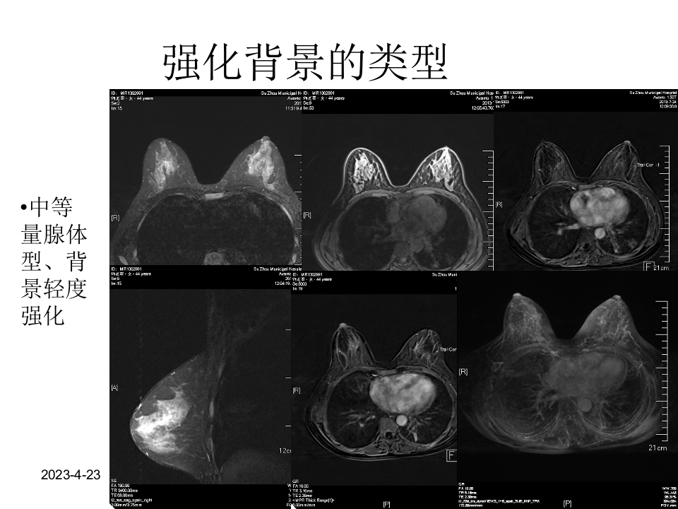 乳腺磁共振规范诊断解读.ppt 第5页