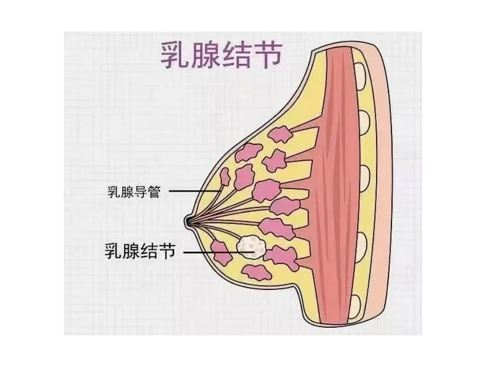 正确对待乳腺结节.pptx 第3页