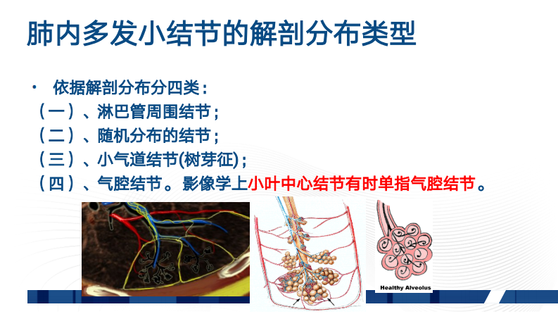 肺部弥漫性病变的HRCT诊断（张同）.pdf 第4页