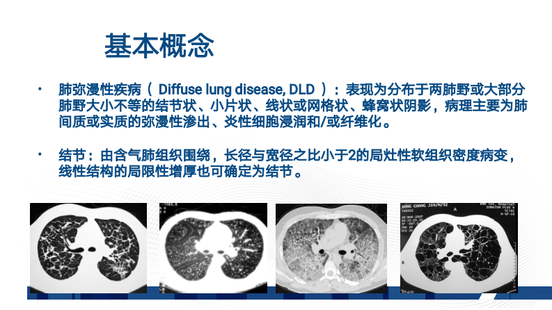 肺部弥漫性病变的HRCT诊断（张同）.pdf 第2页