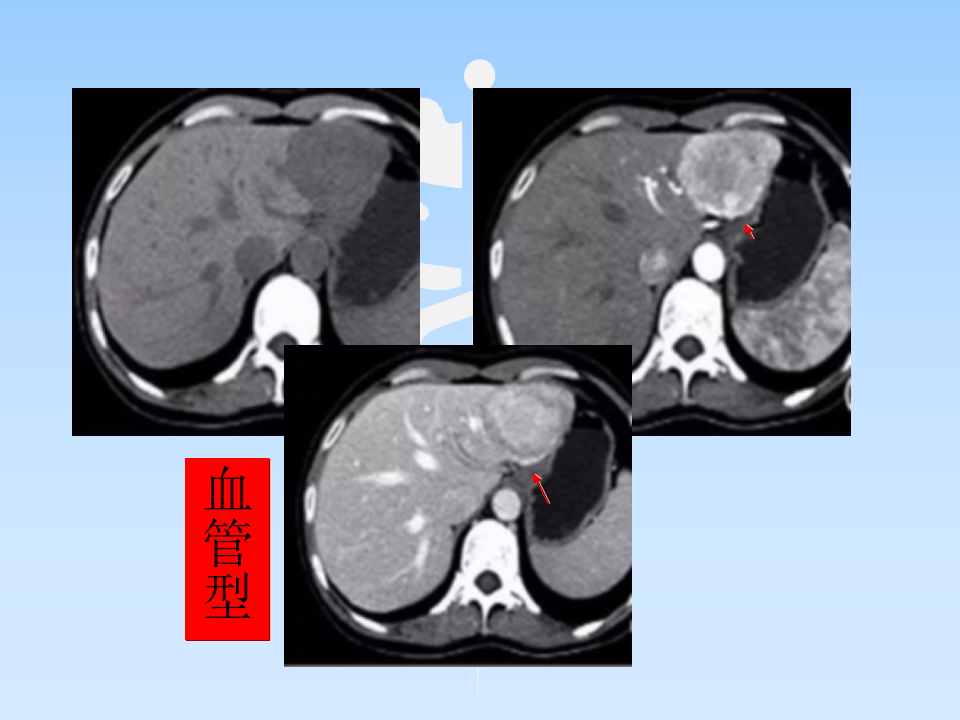 肝AML授课--曾蒙苏.ppt 第5页