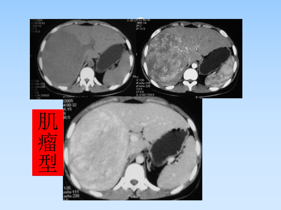 肝AML授课--曾蒙苏.ppt 第4页