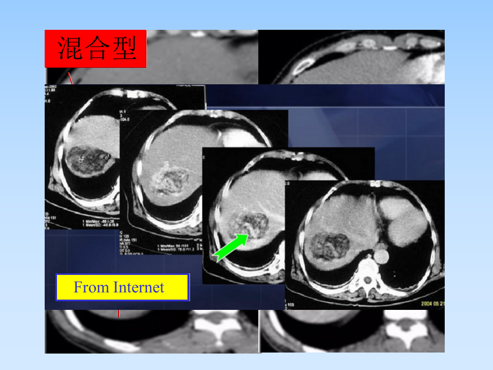 肝AML授课--曾蒙苏.ppt 第3页