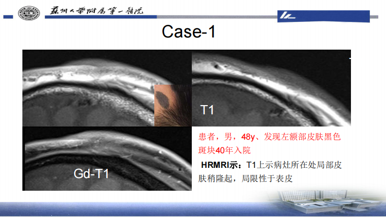 皮肤肿瘤HRMRI成像—李勇刚.pdf 第2页