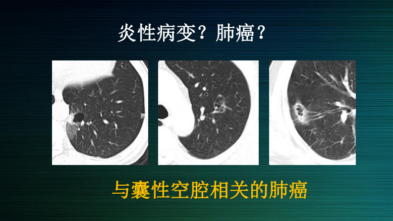伴囊性空腔肺癌的诊断与鉴别--邢伟.pdf 第2页
