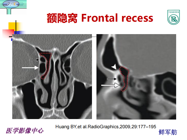 额隐窝及解剖变异与意义--鲜军舫.pdf 第4页