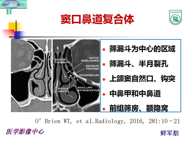 额隐窝及解剖变异与意义--鲜军舫.pdf 第5页