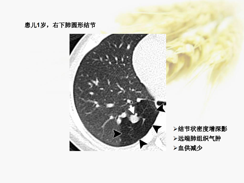 肺部先天性疾病-陈宏伟.pdf 第4页