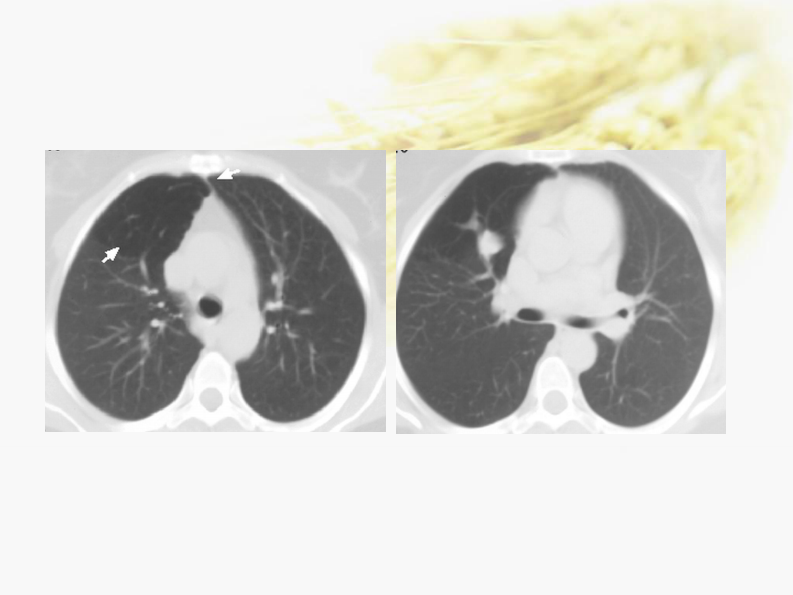 肺部先天性疾病-陈宏伟.pdf 第3页