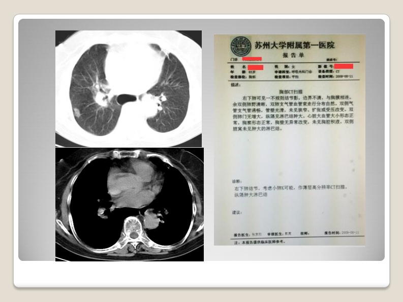 磨玻璃结节的影像分析--郭亮.pdf 第4页