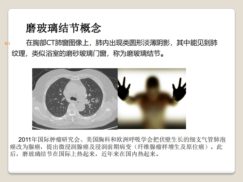 磨玻璃结节的影像分析--郭亮.pdf 第2页