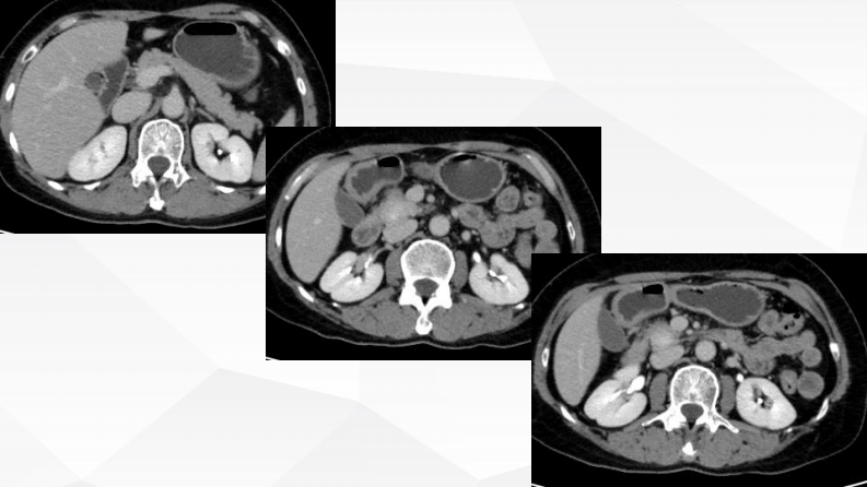 胰腺富血供占位诊断及鉴别诊断--张欢.pdf 第5页