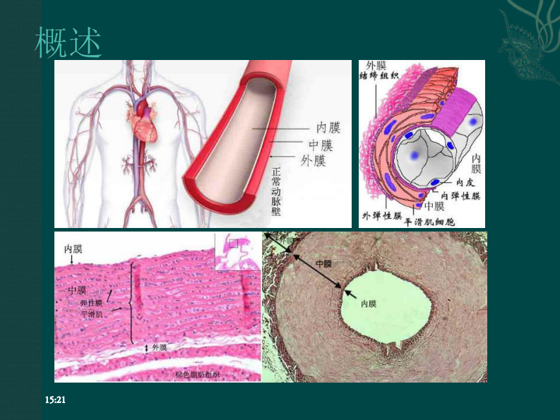 主动脉壁间血肿（IMH）--黄伟.pdf 第2页