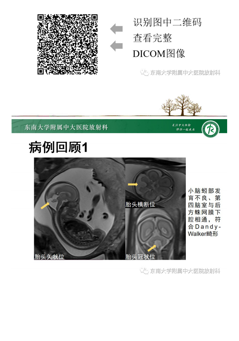 20210329_2【晨读结果公布】2021.03.29神经系统疾病——病例1：Dandy-Walker畸形；病例2：Galen静脉瘤样扩张.pdf 第3页