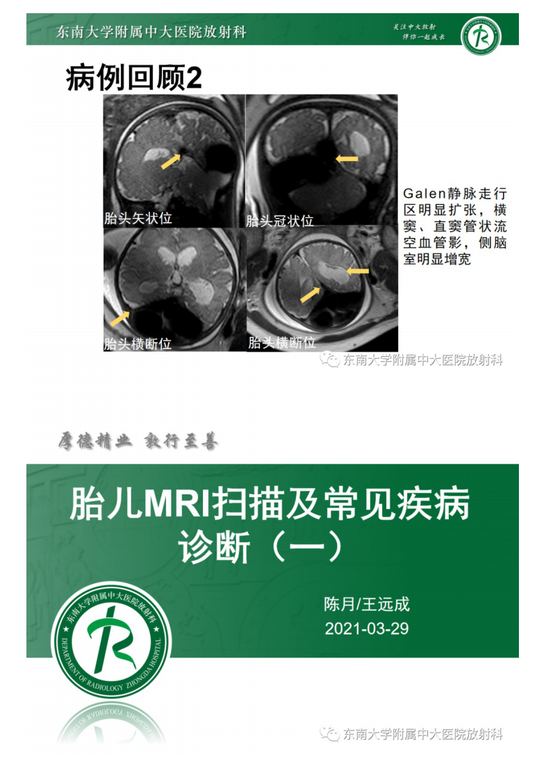 20210329_2【晨读结果公布】2021.03.29神经系统疾病——病例1：Dandy-Walker畸形；病例2：Galen静脉瘤样扩张.pdf 第4页