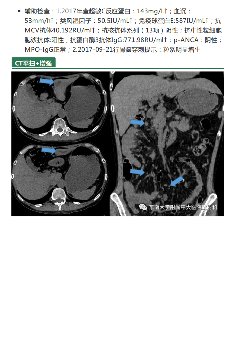 20210621_3【晨读结果公布】2021.06.21消化系统疾病——病例1HELLP；病例2：ANCA相关性血管炎；病例3：原发性肝癌.pdf 第5页