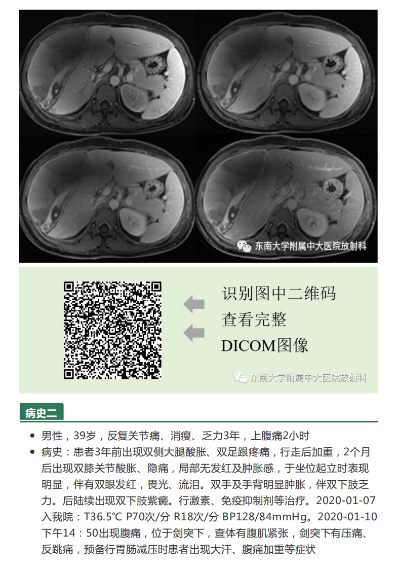 20210621_3【晨读结果公布】2021.06.21消化系统疾病——病例1HELLP；病例2：ANCA相关性血管炎；病例3：原发性肝癌.pdf 第4页