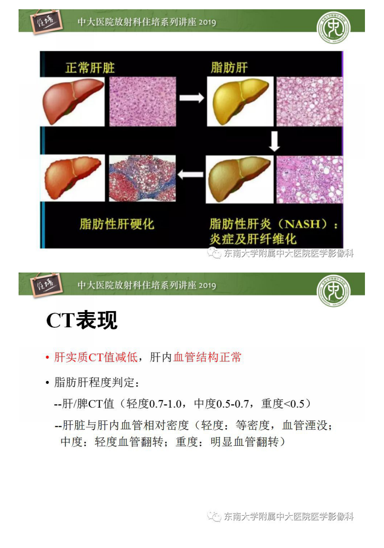 20200211_1【中大放射住培系列讲座】肝脏弥漫性病变影像表现.pdf 第4页