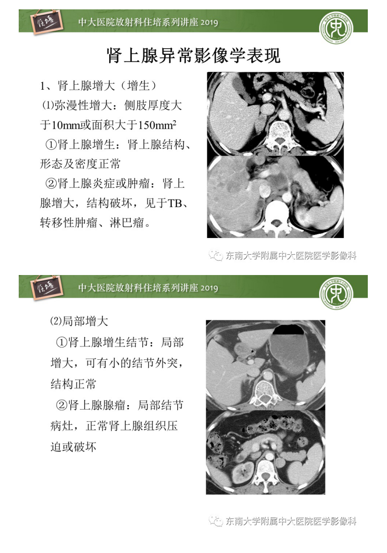 20200407_1【中大放射住培系列讲座】肾上腺病变临床与影像思路分析.pdf 第5页