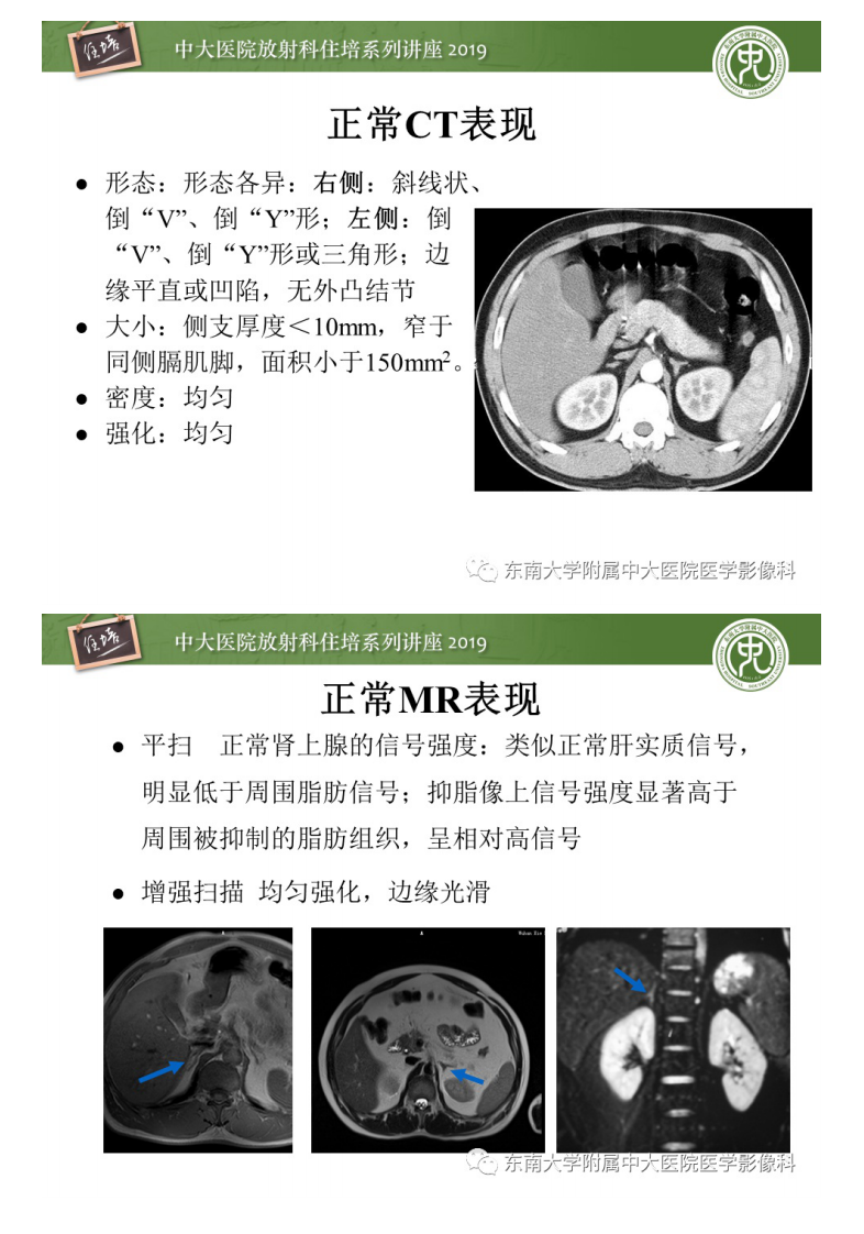 20200407_1【中大放射住培系列讲座】肾上腺病变临床与影像思路分析.pdf 第4页