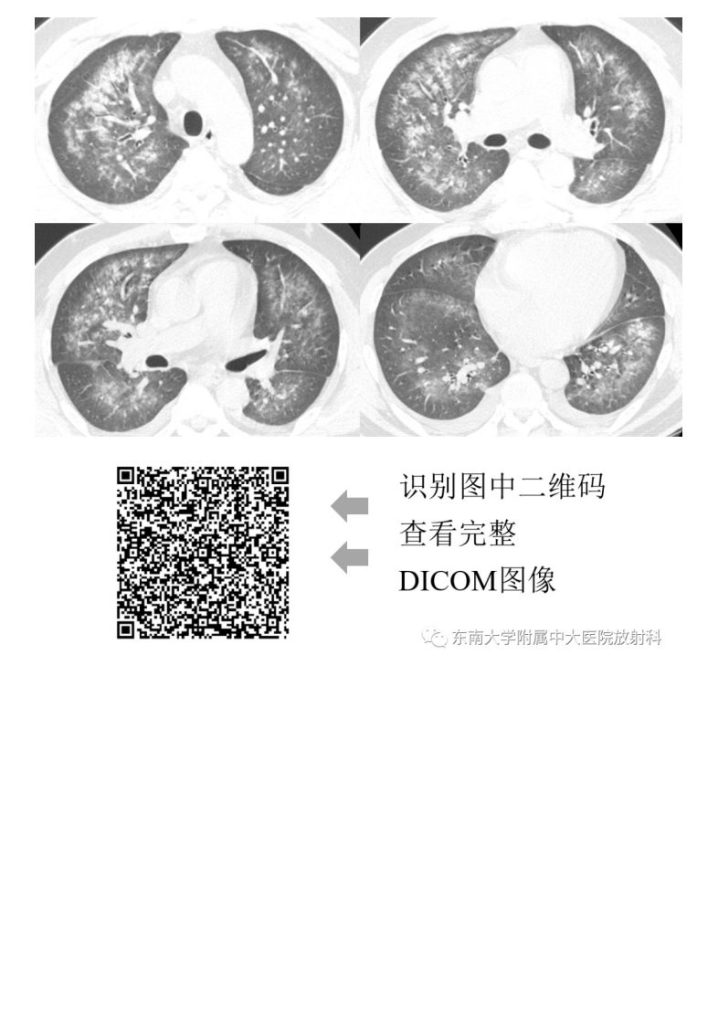 20210412_3【晨读结果公布】2021.04.12呼吸系统疾病——病例1：耶氏肺孢子菌肺炎（PCP）；病例2：急性心源性肺水肿（ACPE）.pdf 第4页