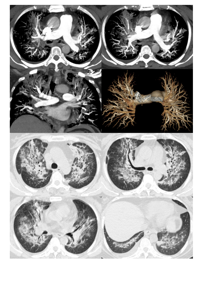 20210412_3【晨读结果公布】2021.04.12呼吸系统疾病——病例1：耶氏肺孢子菌肺炎（PCP）；病例2：急性心源性肺水肿（ACPE）.pdf 第2页