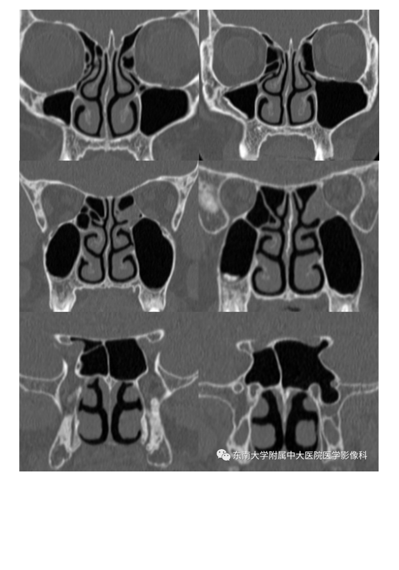 20200707_2【晨读结果公布】2020.07.06头颈部疾病——副鼻窦解剖变异.pdf 第2页