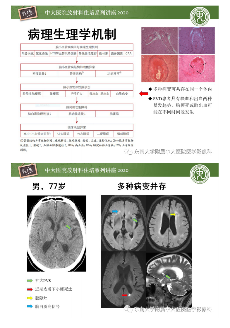 20201108_1【中大放射住培系列讲座】脑小血管病影像解读.pdf 第5页