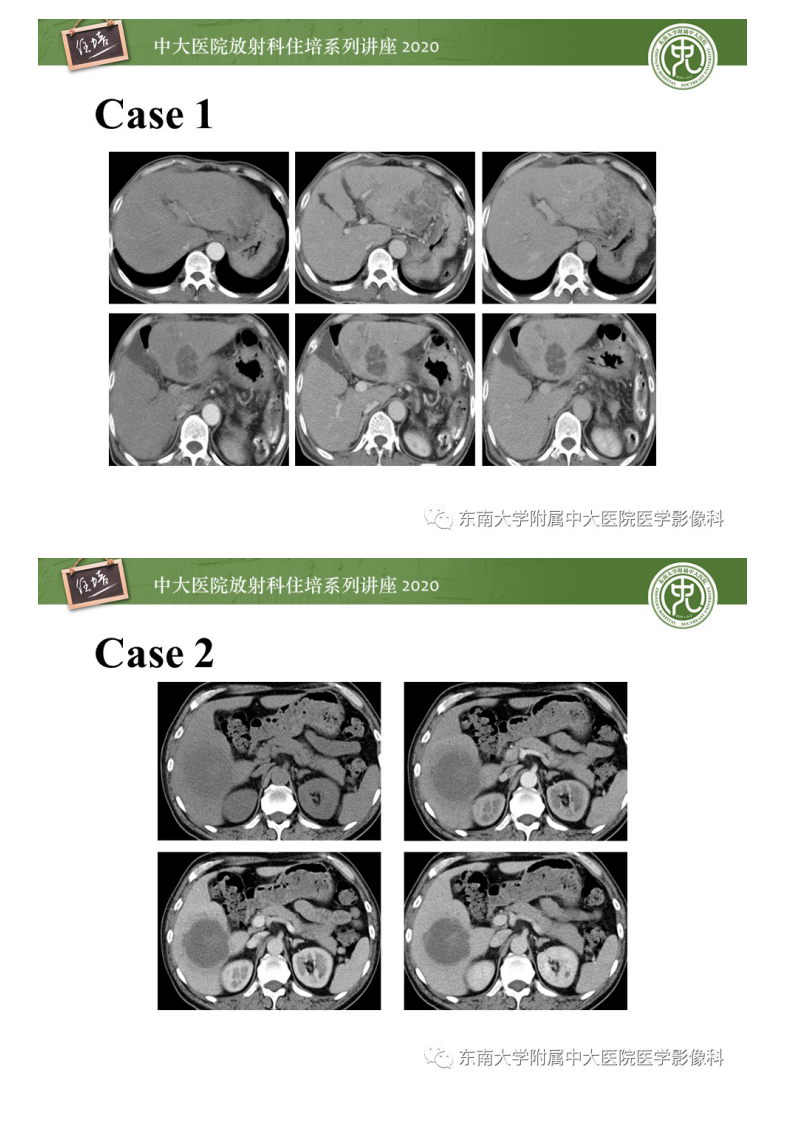 20201101_1【中大放射住培系列讲座】肝脏感染性病变的诊断及鉴别.pdf 第2页