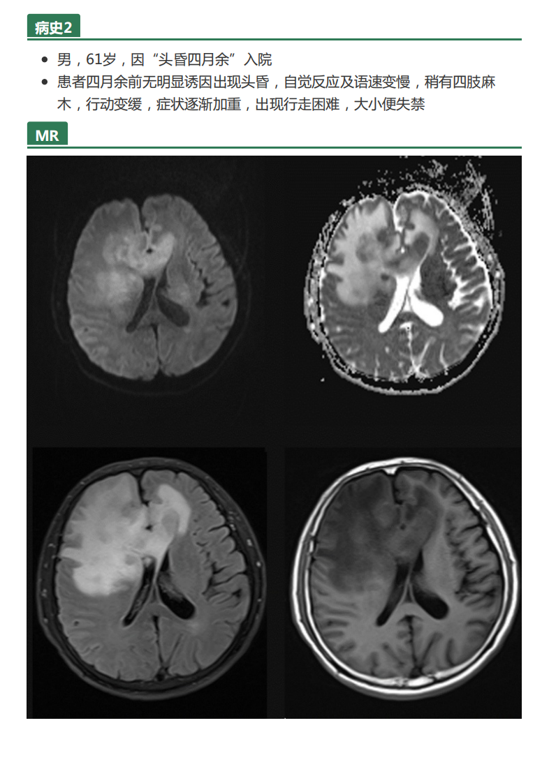 20210608_2【晨读结果公布】2021.06.07神经系统疾病——病例1：间变型少突胶质细胞瘤；病例2：PCNSL；病例3：胼胝体急性梗死.pdf 第4页