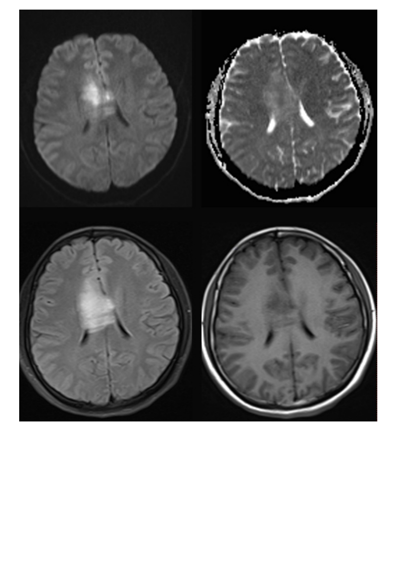 20210608_2【晨读结果公布】2021.06.07神经系统疾病——病例1：间变型少突胶质细胞瘤；病例2：PCNSL；病例3：胼胝体急性梗死.pdf 第2页