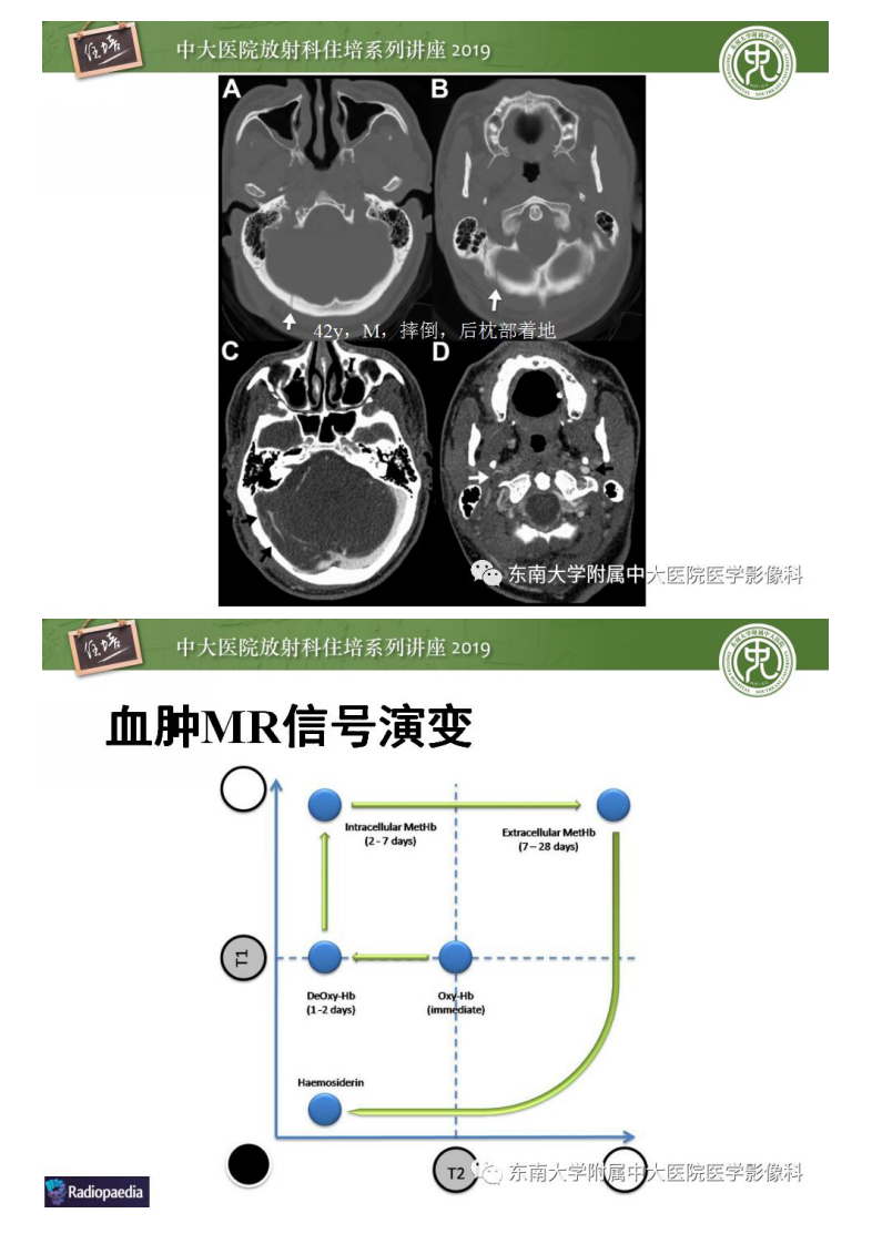 20190224_1【中大放射住培系列讲座第50期】成人颅脑损伤影像评估基本原则.pdf 第5页