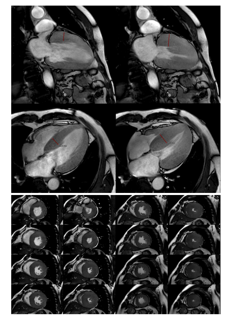 20210601_3【晨读结果公布】2021.05.31循环系统疾病——病例1：肥厚型心肌病；病例2：主动脉瓣膜病变继发改变.pdf 第2页