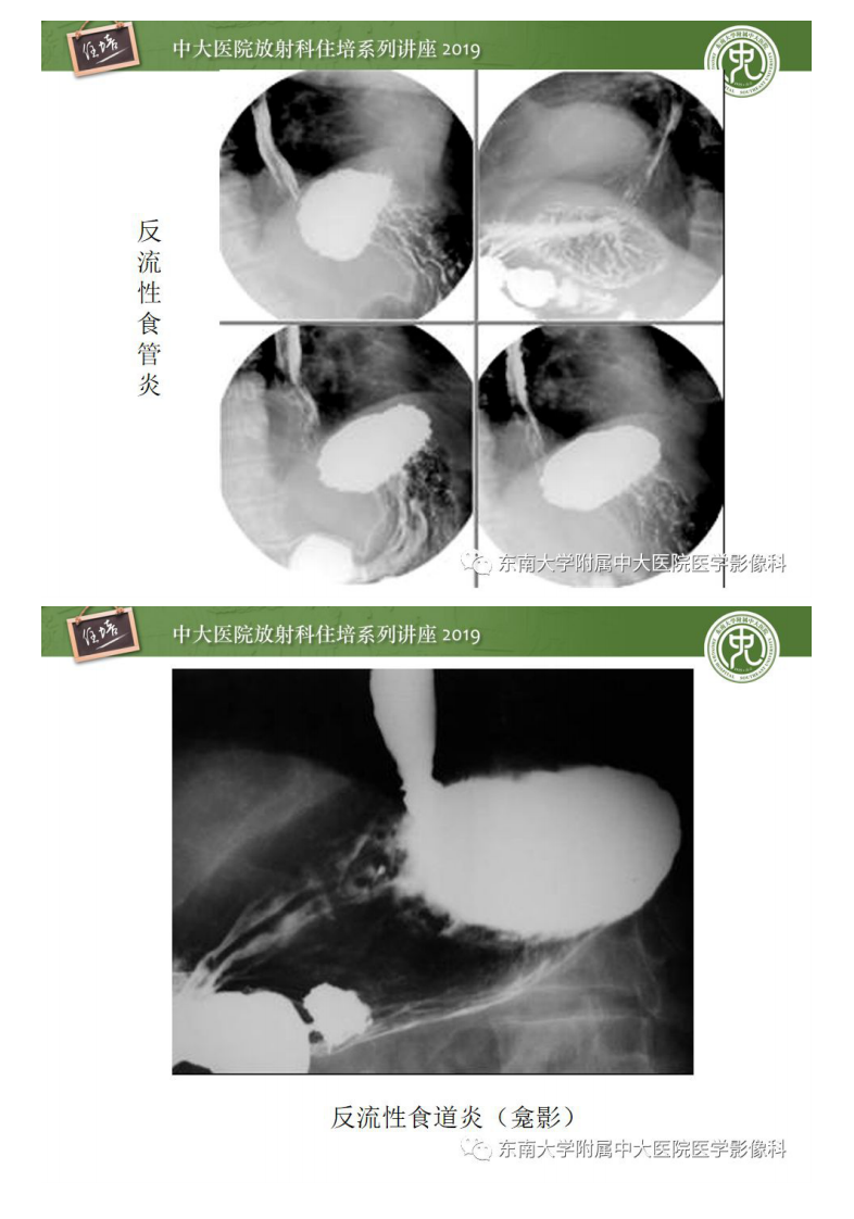 20200220_1【中大放射住培系列讲座】食管常见疾病的诊断和鉴别诊断.pdf 第4页