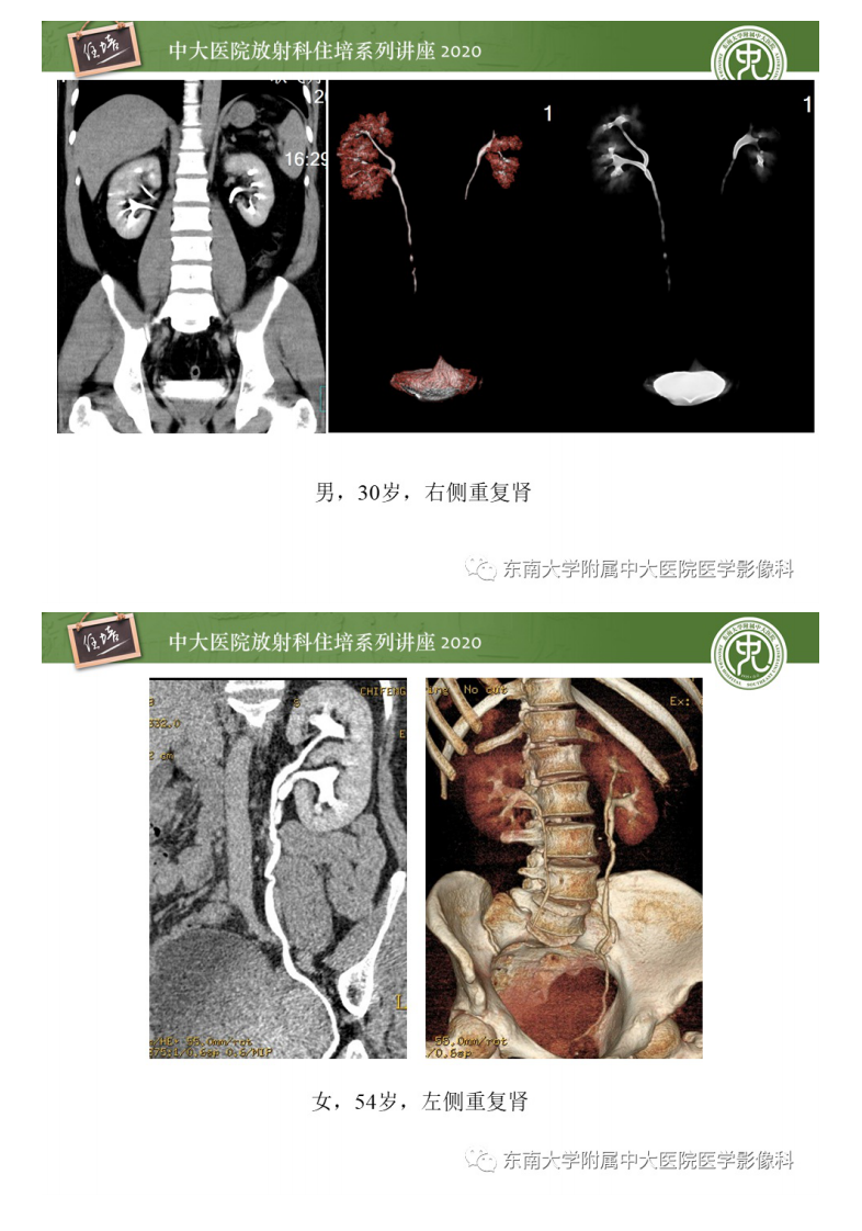 20201116_1【中大放射住培系列讲座】泌尿系统先天发育异常的影像表现.pdf 第5页