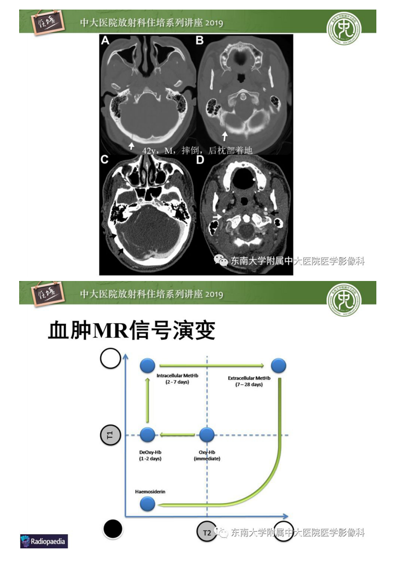 20200203_1【中大放射住培系列讲座】成人颅脑损伤影像评估基本原则.pdf 第5页