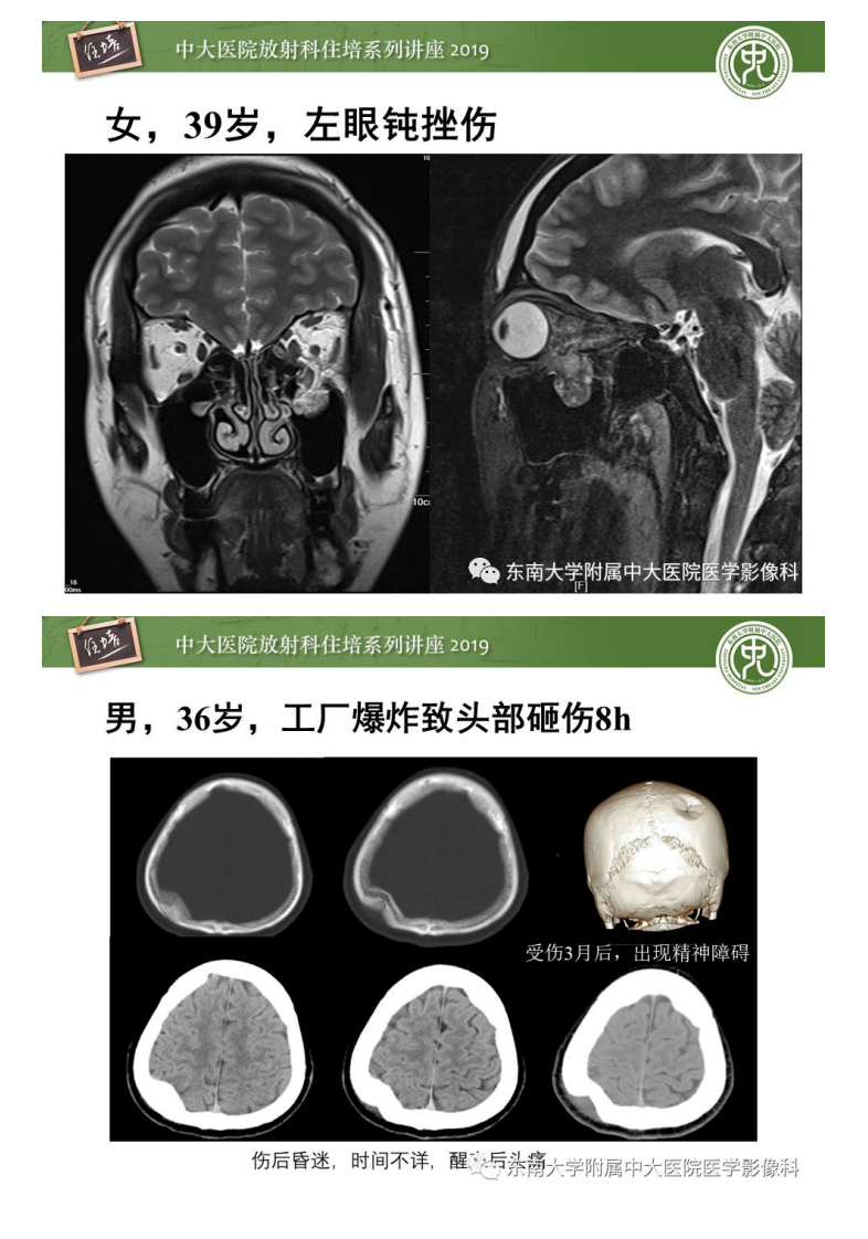 20200203_1【中大放射住培系列讲座】成人颅脑损伤影像评估基本原则.pdf 第4页