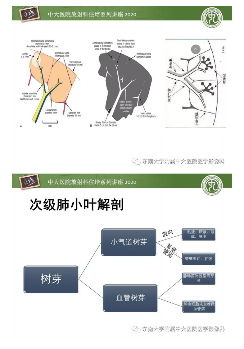 20200520_1【中大放射住培系列讲座】肺内常见影像征象解读（树芽征、指套征）.pdf 第4页