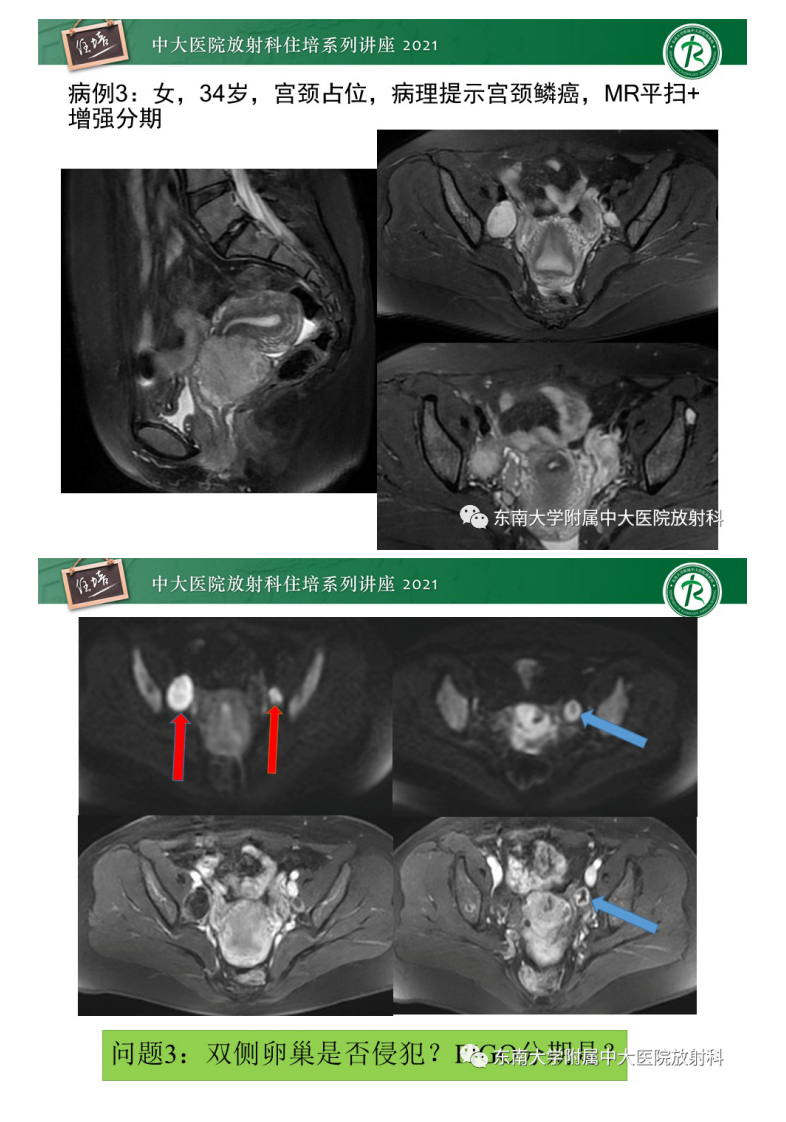 20210627_2【中大放射住培系列讲座】卵巢黄体及相关疾病诊断及鉴别.pdf 第5页