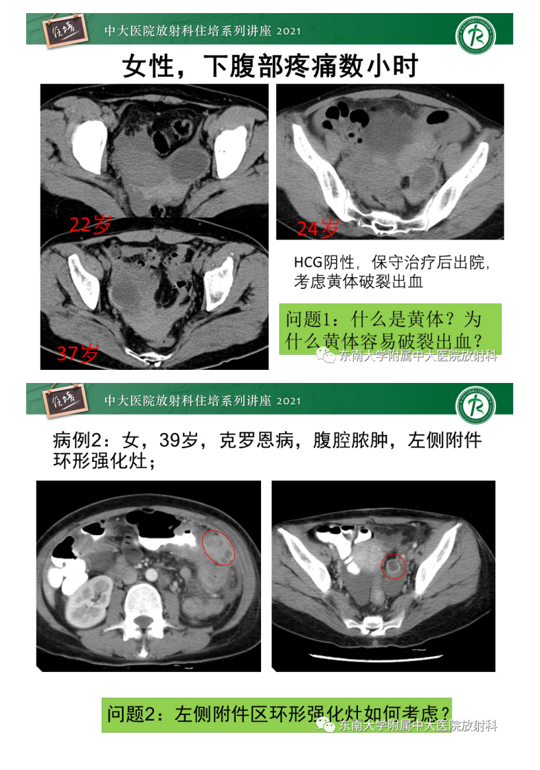 20210627_2【中大放射住培系列讲座】卵巢黄体及相关疾病诊断及鉴别.pdf 第4页