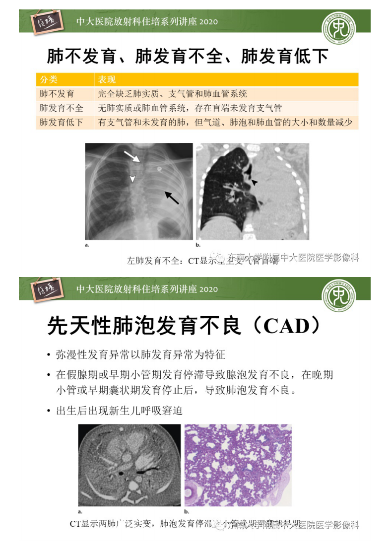 20200810_1【中大放射住培系列讲座】新生儿呼吸窘迫的影像诊断及分析.pdf 第4页