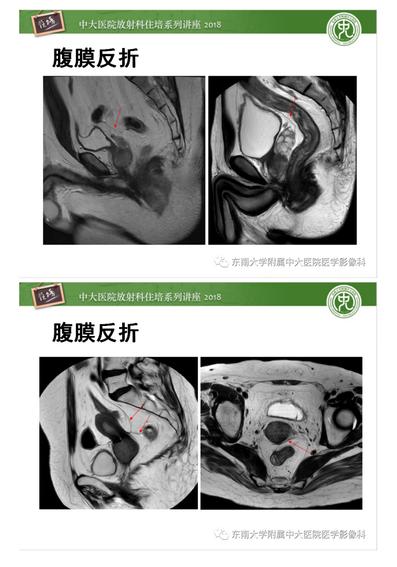 20200409_1【中大放射住培系列讲座】直肠癌MR分期及报告.pdf 第4页
