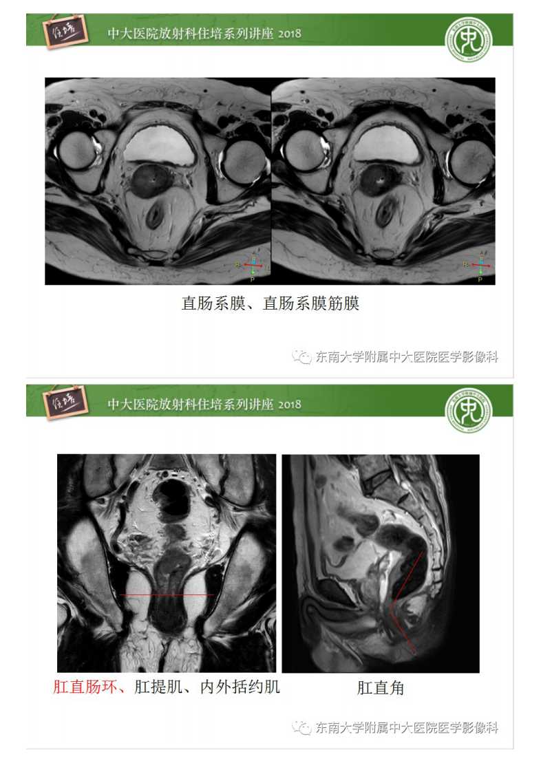 20200409_1【中大放射住培系列讲座】直肠癌MR分期及报告.pdf 第5页