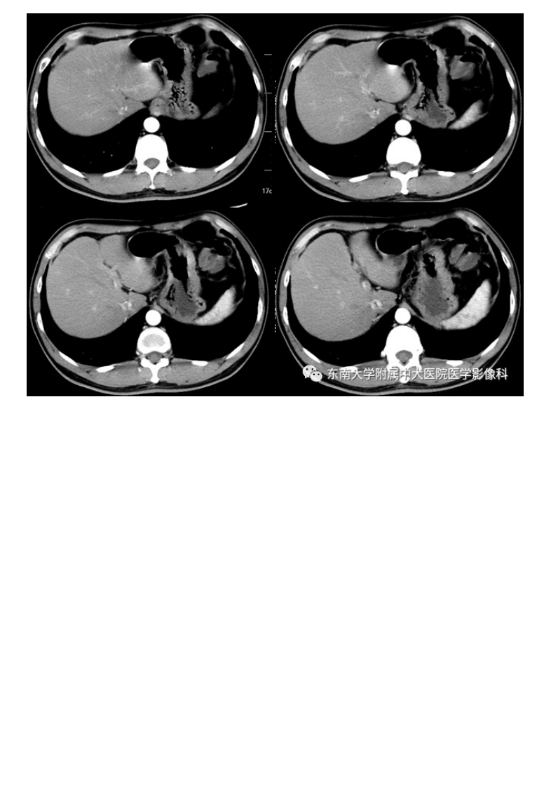 20210113_2【晨读结果公布】2021.01.13消化系统疾病——胃内异位胰腺.pdf 第2页